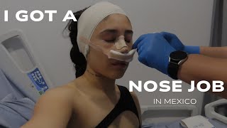 I Got A Rhinoplasty In MEXICO! | Vlog | PT 1 | 🇲🇽