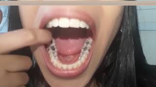 Girl Gives Us A Tour Of Her Mouth Showing Her Dental Amalgams