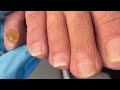 Toenail Transformation You Have To See!