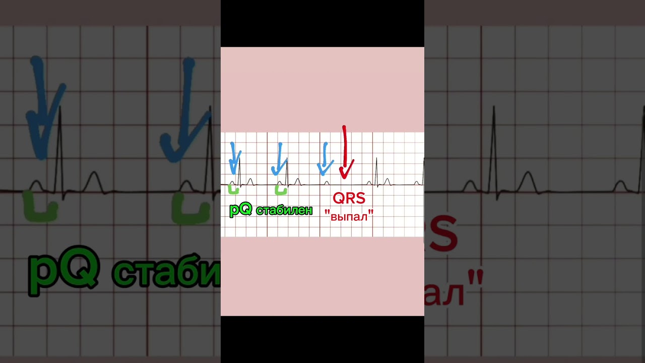 АВ-блокада II Мобитц 2 #ecg #ekg #экг