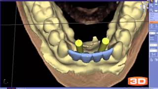 Implant Plan Review  Lower Anterior Implant Bridge