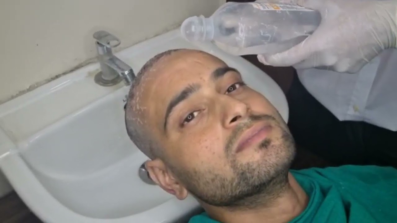 हेयर ट्रांसप्लांट के बाद सिर कब और कैसे धोएं( दिन 3 ) - - MBBS MD (MAMC) (स्किन)- हिंदी २०२२