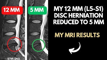 12 mm Disc Herniation Reduced to a 5 mm - 12 Weeks of Limitless Transformation