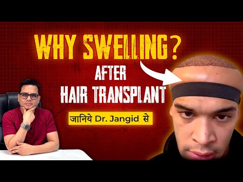 How to Deal with Swelling After a Hair Transplant - What to do? - video