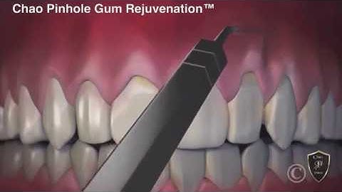 The Difference Between Gum Grafting and Chao Pinhole Surgical Technique