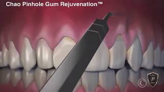 The Difference Between Gum Grafting and Chao Pinhole Surgical Technique