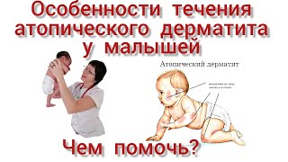 Особенности атопического дерматита у младенцев.. Как его предотвратить?