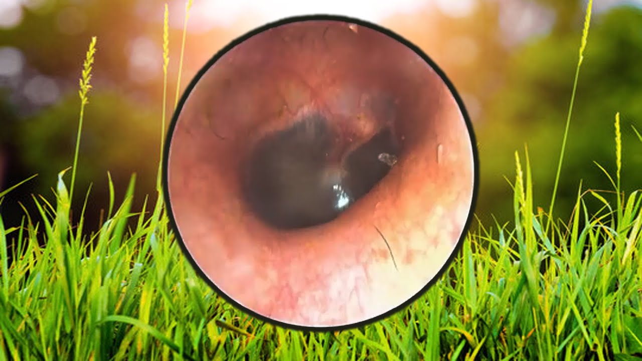 クリネール耳垢除去 clinere ear wax removal Part 269 YouTube