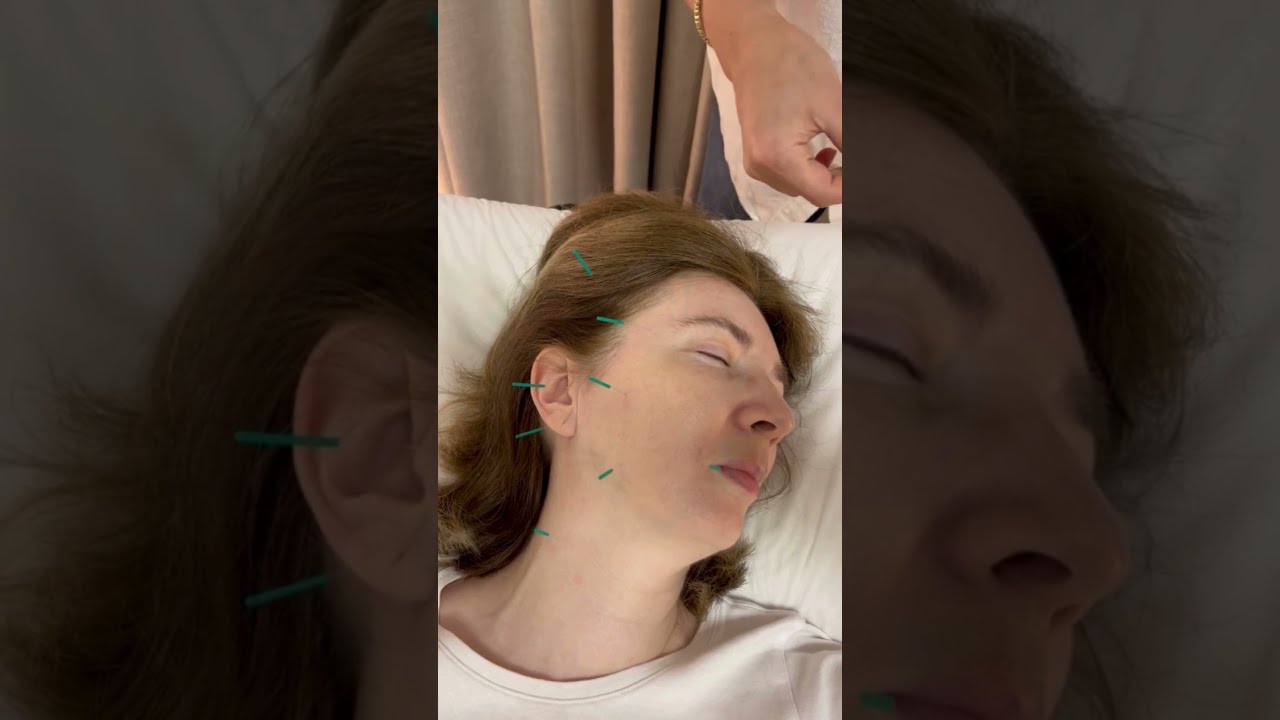 Facial acupuncture. It's Juyon Kim  from Tel Aviv Acupunsture.