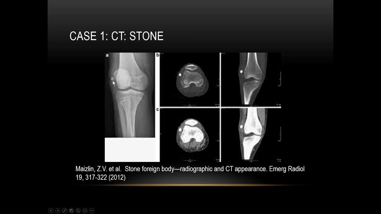 Imaging of Foreign Bodies | 15 Minute Radiology CME