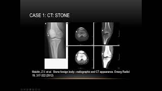 Imaging of Foreign Bodies | 15 Minute Radiology CME screenshot 4