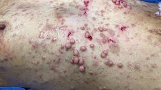 Cutaneous Neurofibroma (cNF) Removal Simplified