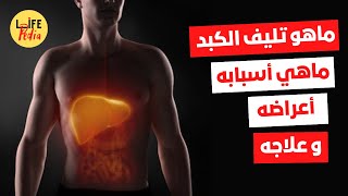 أعراض تليف الكبد : هل تليف الكبد يسبب الوفاة