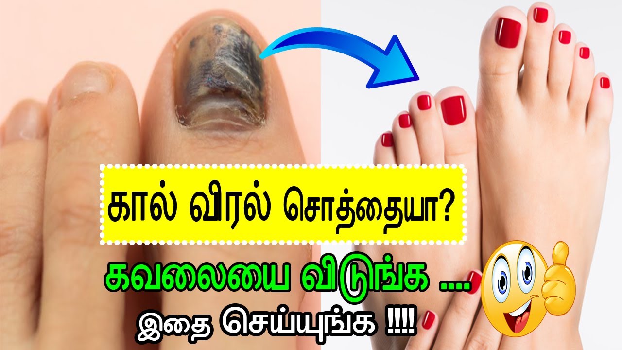 உங்கள் நகங்கள் காட்டும் நோய் அறிகுறிகள் | Nail disease - YouTube