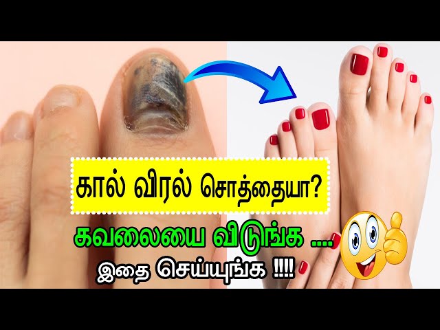 How to Use Tea tree oil for Nail Fungus? - House of Pure Essence (HoPE)