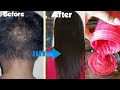 Apply Once A Week and Say Bye to  Baldness, Alopecia and Your Hair Will Never Stop Growing
