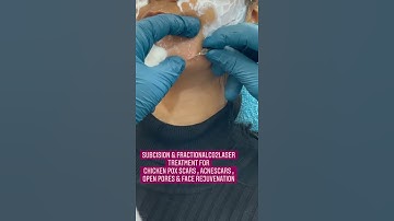 Thumbnail of Subcision & FractionalCO2laser treatment for chicken Pox Scars| open pores|acne scars
