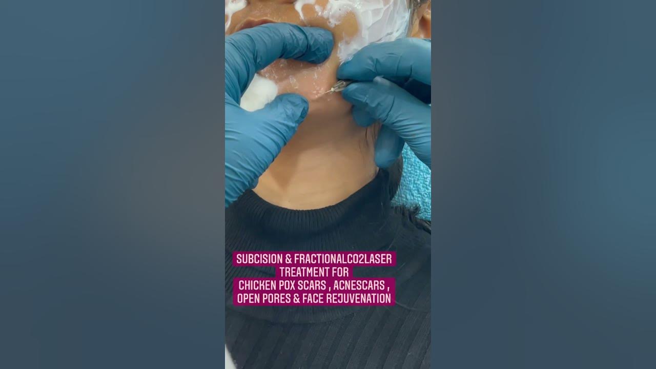 Subcision & FractionalCO2laser treatment for chicken Pox Scars| open pores|acne scars