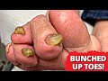 How Does She Wear Shoes?! 🤯 Toenail Cutting On Mangled Toes!