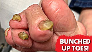 How Does She Wear Shoes?! 🤯 Toenail Cutting On Mangled Toes!