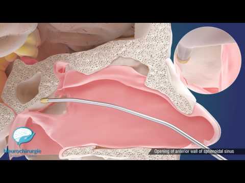 What Pituitary Adenoma