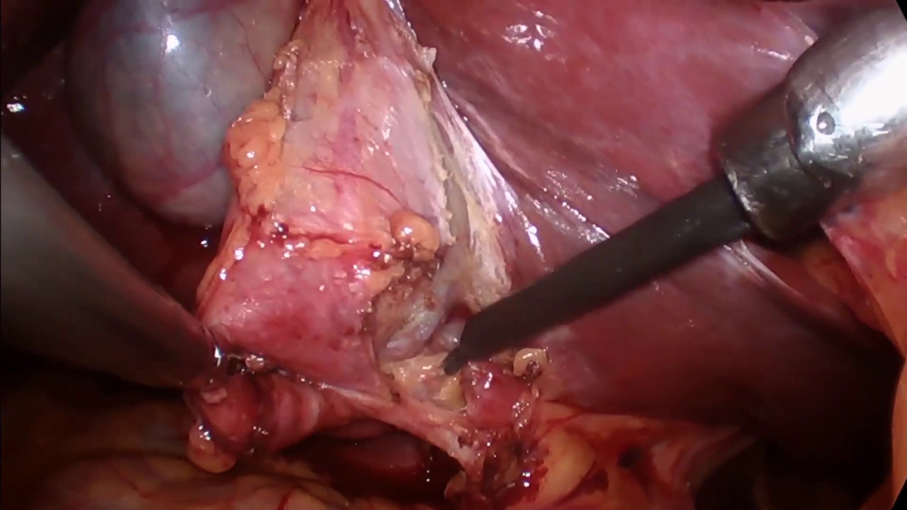 Cálculo de vesícula / Gallbladder calculus virgilio liceo