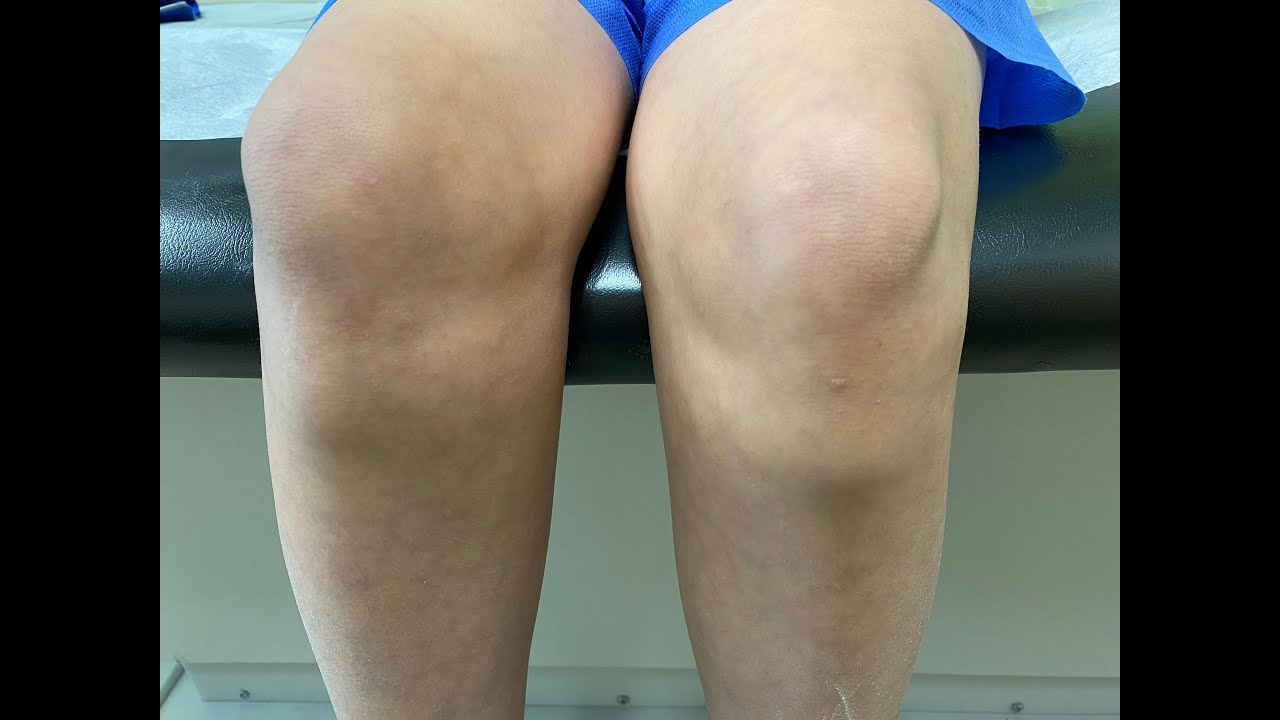 Osgood Schlatter's Disease: A Common Cause of Knee Pain in Growing Kids