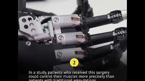 Video: New surgery likely to enable better control of prosthetic limbs