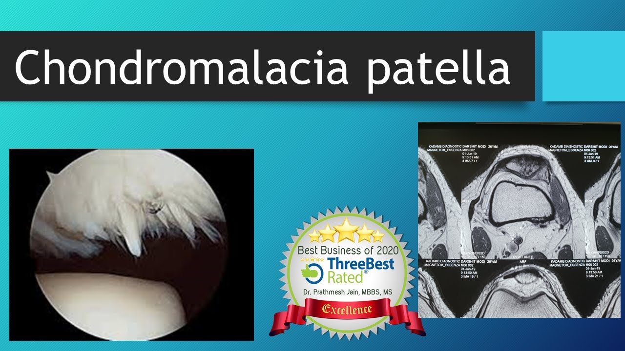 Chondromalacia Patella (All you want to know About) สรุปเนื้อหาที่