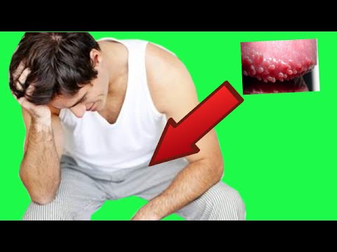 Video: 3 formas de eliminar las pápulas perladas del pene