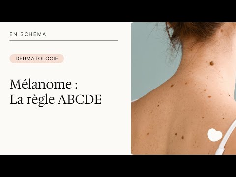 Cancer de la peau : comment le prévenir ? La règle ABCDE - video from MedecinDirect