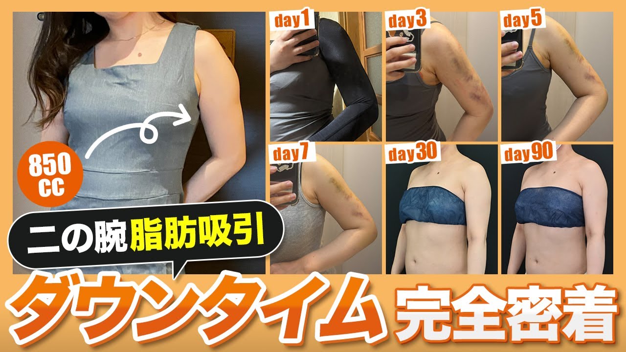 完全密着】生活に支障ある？二の腕の脂肪吸引のダウンタイムの全て