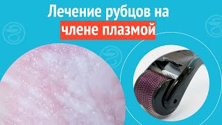 💉 Лечение Рубцов На Члене Плазмой. Клинический Случай №1339