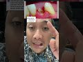 GIGINYA COPOT SENDIRI SETELAH DIPERIKSA AKAR GIGINYA TERTINGGAL ITU YG BIKIN SAKIT GIGI #sakitgigi