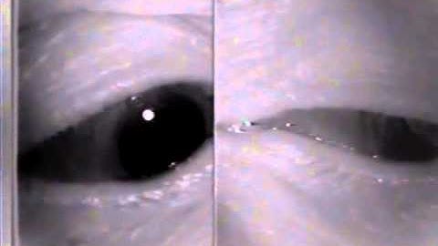 Aberrant Regeneration of Third Nerve, Bilaterally (1 degree OD, 2 degrees OS)
