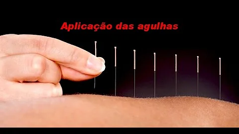 Como aplicar as agulhas de acupuntura?