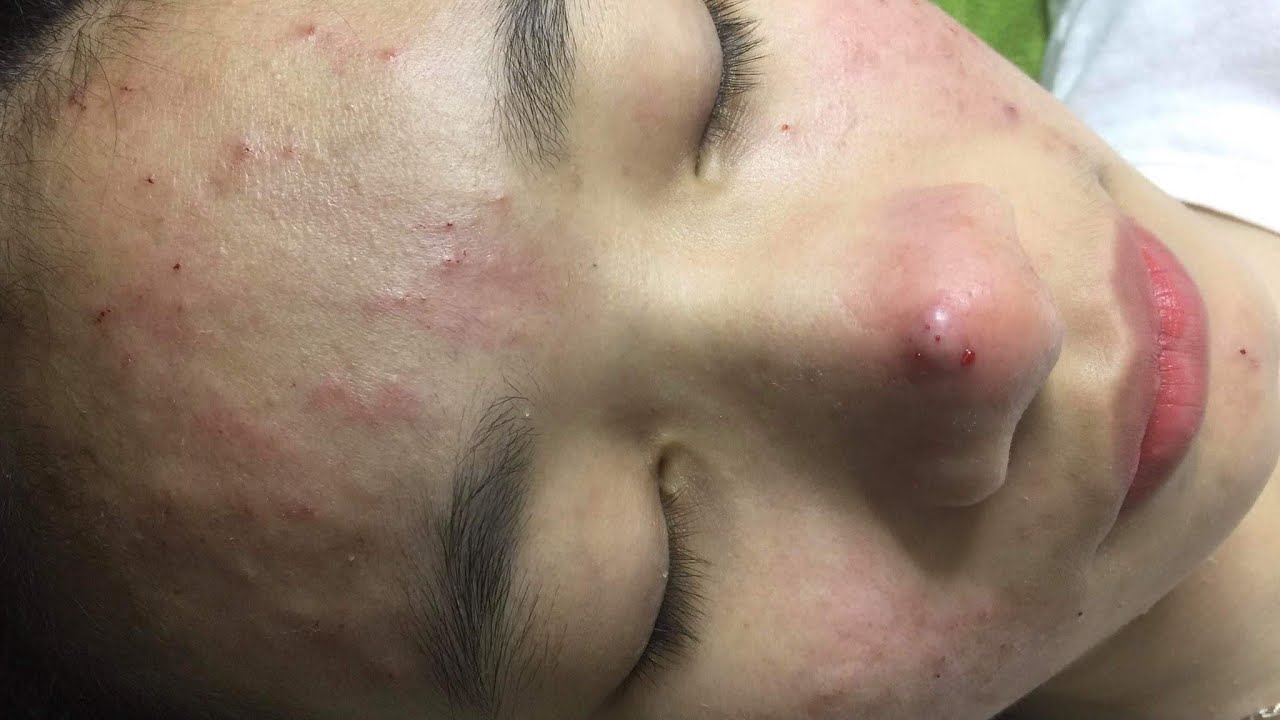 The change when treating acne at Spa Linh Mun