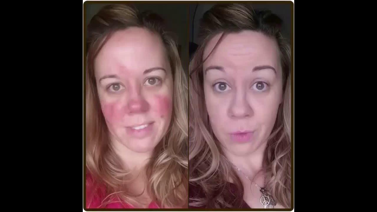 Makeup Tutorial for Rosacea! YouTube