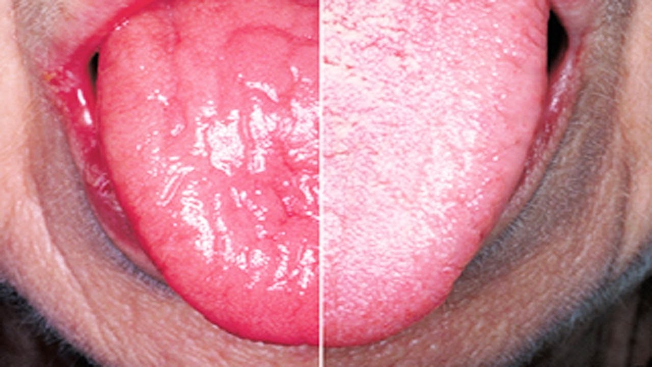 Dry Mouth - Natural Home Remedies for Dry Mouth 