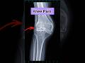 Knee Pain Therepy