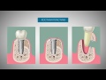 Видеоблог стоматолога  Вся правда об имплантации