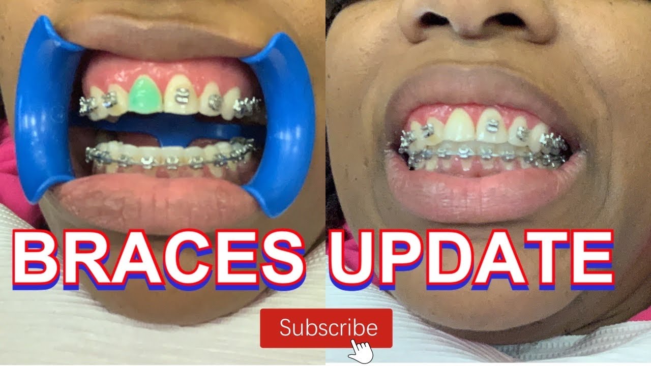 14TH BRACES UPDATE / ORTHO APPT YouTube