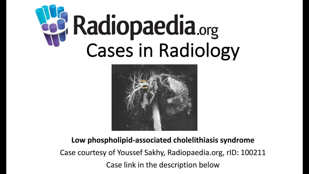 Low phospholipidassociated cholelithiasis syndrome