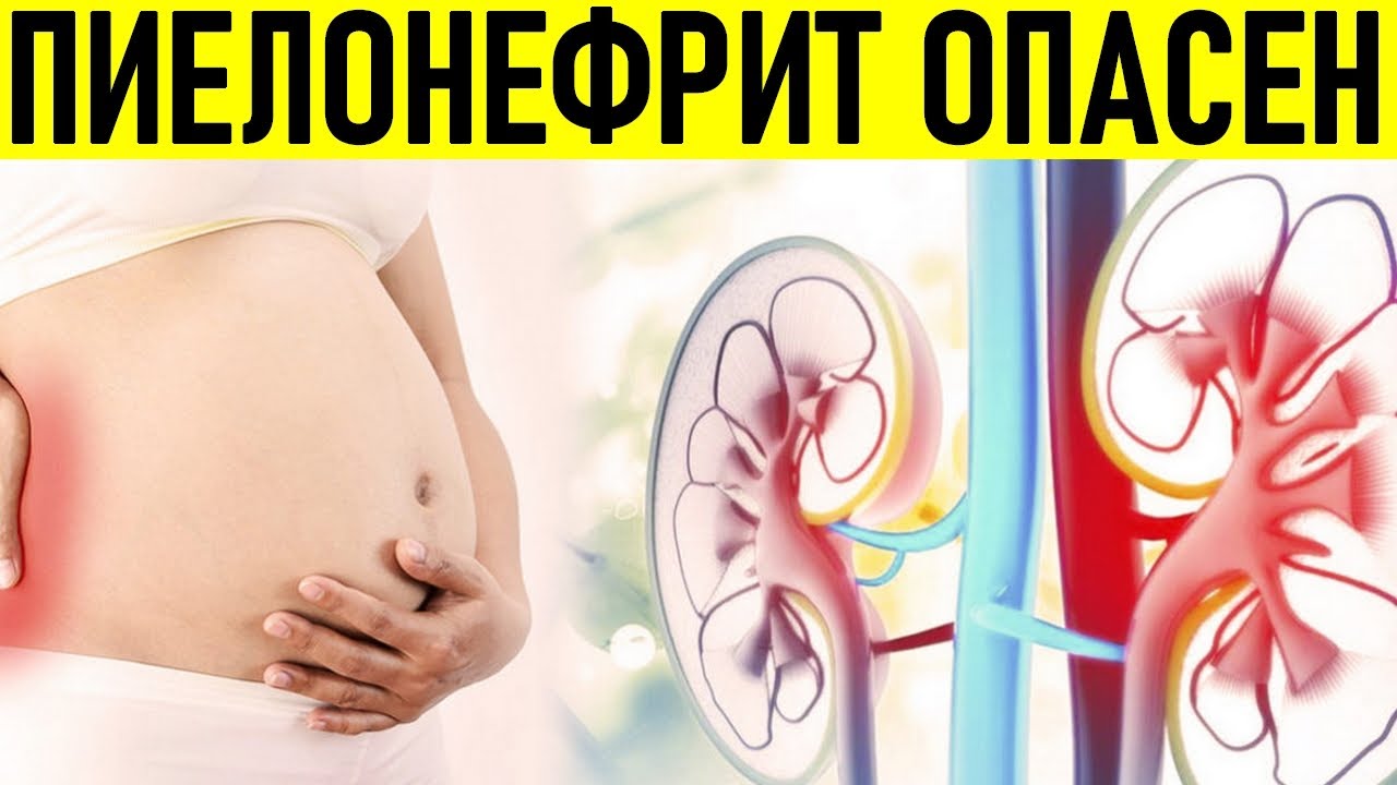 ПИЕЛОНЕФРИТ ВО ВРЕМЯ БЕРЕМЕННОСТИ | Причины и лечение пиелонефрита когда беременна