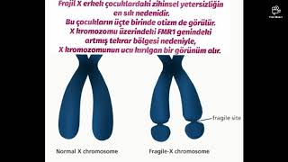 Otizm Tedavisi Frajil X Sendromu Resimi