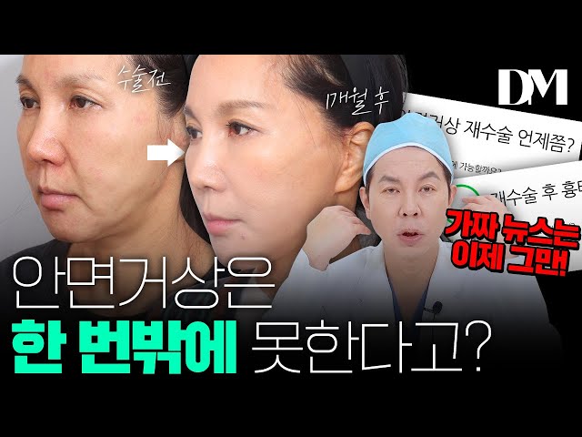 안면거상은..평생 한 번 밖에 못한다??😮  안면거상 재수술에 대해서 알려드릴게요!  #안면거상 #리프팅 #안면거상재수술