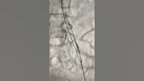 Reverse CART technique