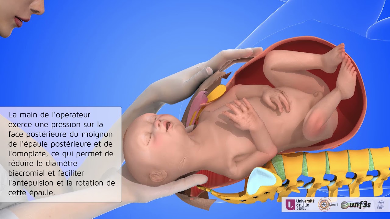 La dystocie des épaules, une urgence obstétricale