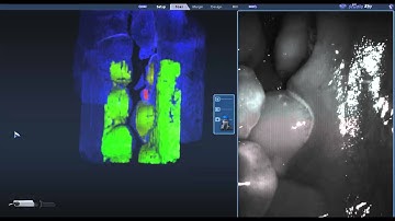 Scanning with E4D-Planmeca Planscan