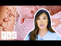 Dr lees most interesting cases mysterious rashes cysts  more  dr pimple popper